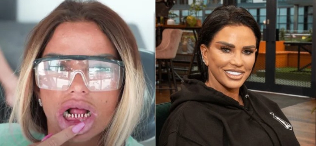 Katie Price’s Teeth celebrity veneers before and after Antalya, Turkey